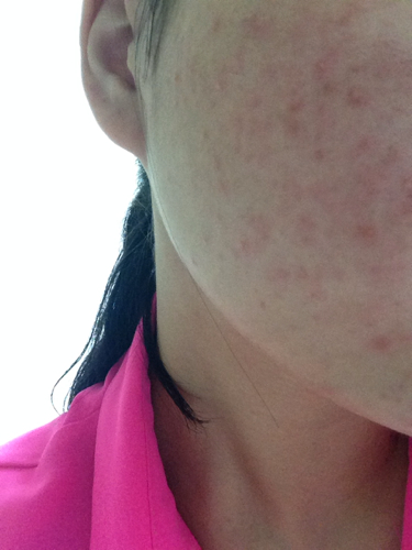 臉上突然長了好多紅色的痘痘,原因、治療與預防,臉部紅色痘痘,成因、治療與預防措施