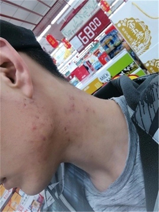 臉上突然長了好多紅色的痘痘,原因、治療與預防,臉部紅色痘痘,成因、治療與預防措施