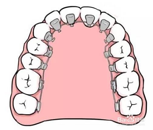 牙套價格詳解，裝一個牙套需要多少錢？，牙套價格全解析，裝牙套需要多少錢？