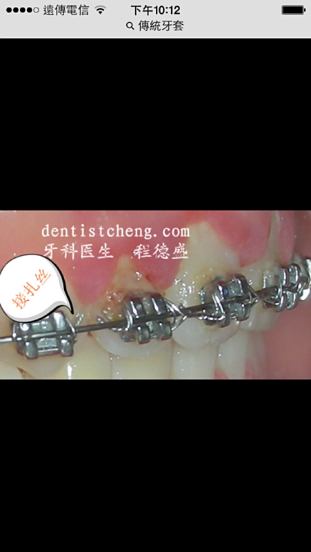 牙套價格詳解,裝一個牙套需要多少錢?,牙套價格全解析,裝牙套需要多少錢?