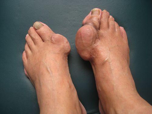 尿酸高最快的恢復(fù)方法,全面解析與行動(dòng)指南,尿酸高患者必看,全面解析與行動(dòng)指南,快速恢復(fù)健康之道