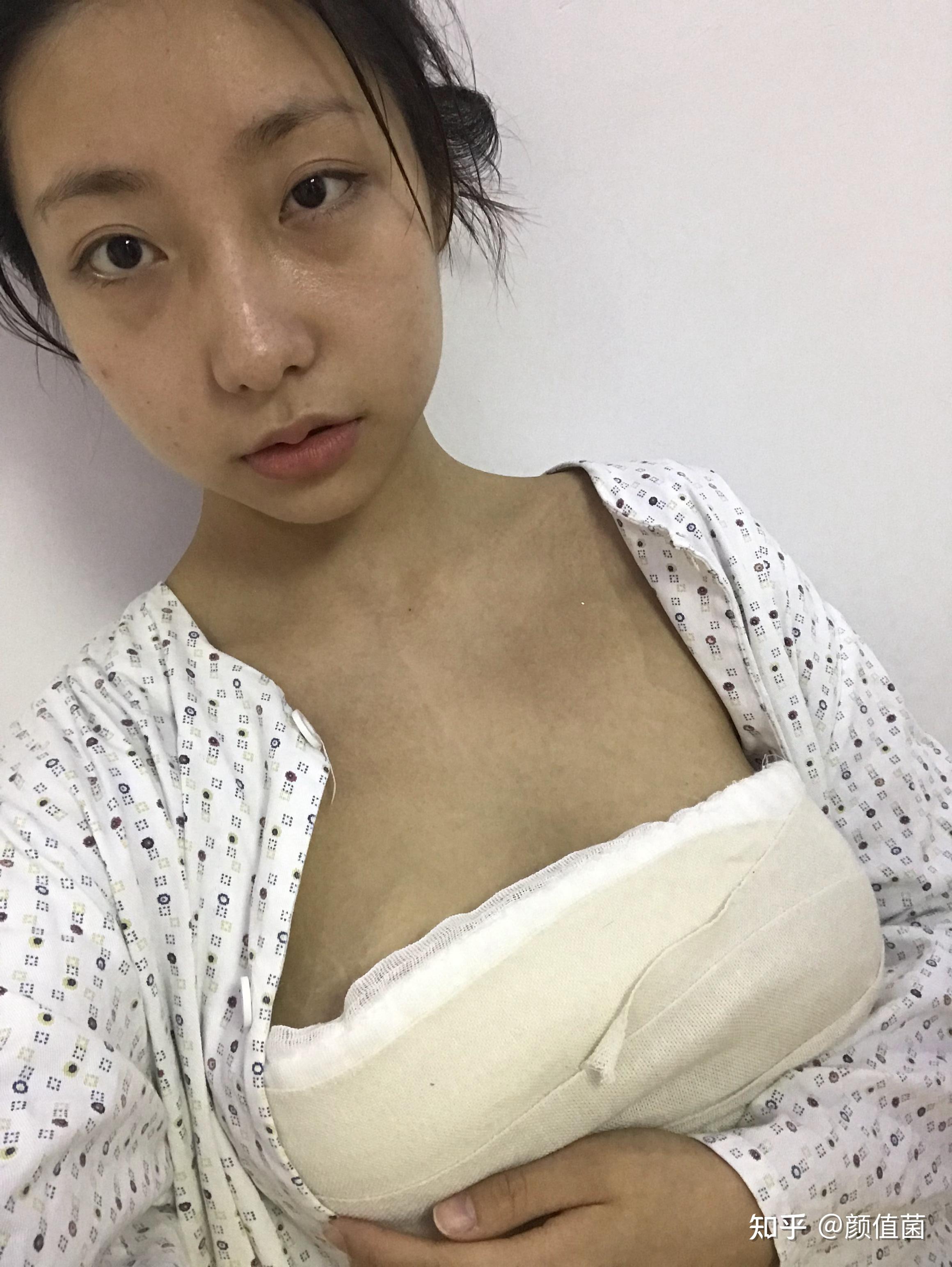 自體脂肪隆胸的真實(shí)經(jīng)歷分享,自體脂肪隆胸的真實(shí)體驗(yàn)分享