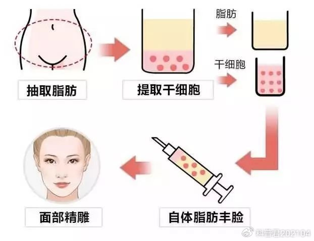 面部脂肪填充效果持久性解析,能保持幾年?,面部脂肪填充效果的持久性解析,能維持多少年?