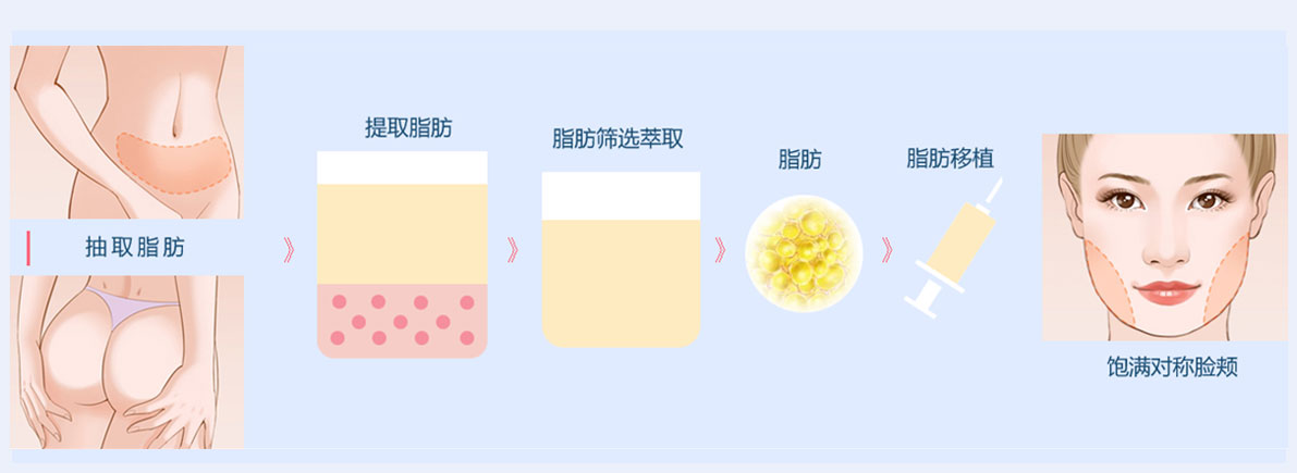 面部脂肪填充效果持久性解析,能保持幾年?,面部脂肪填充效果的持久性解析,能維持多少年?