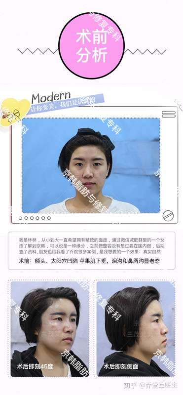 面部脂肪填充效果持久性解析,能保持幾年?,面部脂肪填充效果的持久性解析,能維持多少年?