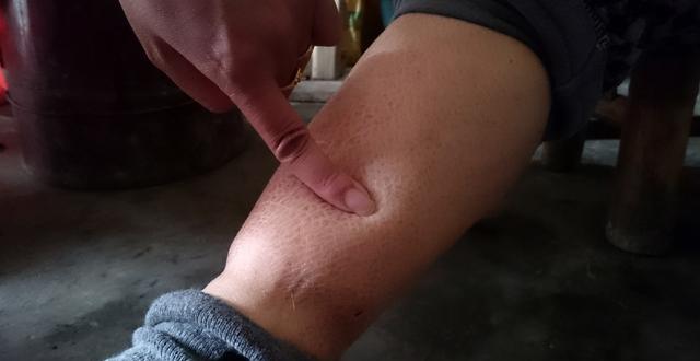 小腿浮腫一按一個坑,原因、治療與預防,小腿浮腫原因、治療及預防方法,一按一個坑的困擾