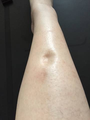 小腿浮腫一按一個坑,原因、治療與預防,小腿浮腫原因、治療及預防方法,一按一個坑的困擾