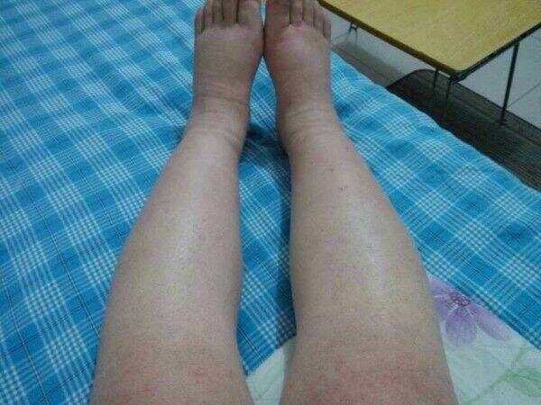 小腿浮腫一按一個坑,原因、治療與預防,小腿浮腫原因、治療及預防方法,一按一個坑的困擾