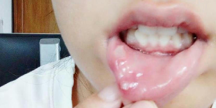 口腔潰瘍最快自愈方法，自然恢復(fù)與預(yù)防策略，口腔潰瘍自然恢復(fù)與預(yù)防策略，快速自愈方法及日常預(yù)防建議