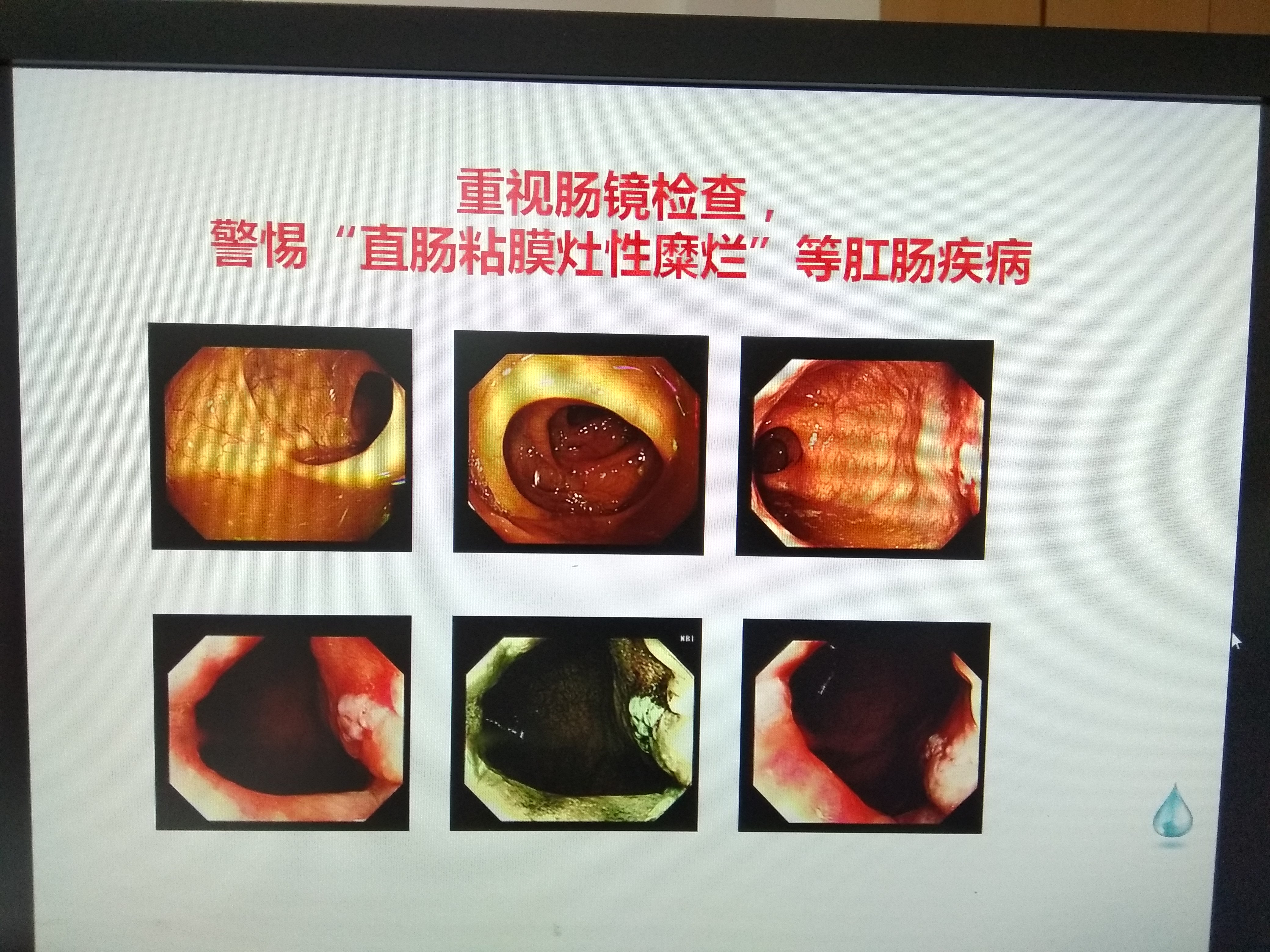 腸鏡檢查，一次不愉快的經(jīng)歷，腸鏡檢查，一次難忘的不愉快體驗