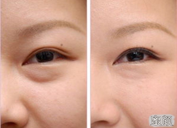 如何消除眼袋，簡單實用的方法，消除眼袋的實用方法與技巧