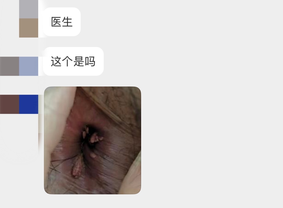 如何判斷得了肛門疣——癥狀、診斷與應對策略，肛門疣的癥狀、診斷及應對策略指南