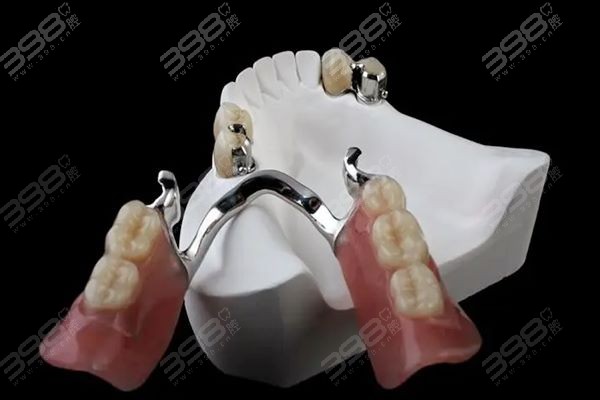 鑲一顆牙大概需要多少錢——全面解析鑲牙費用因素，鑲一顆牙的費用解析，全面探討鑲牙費用因素及大概價格