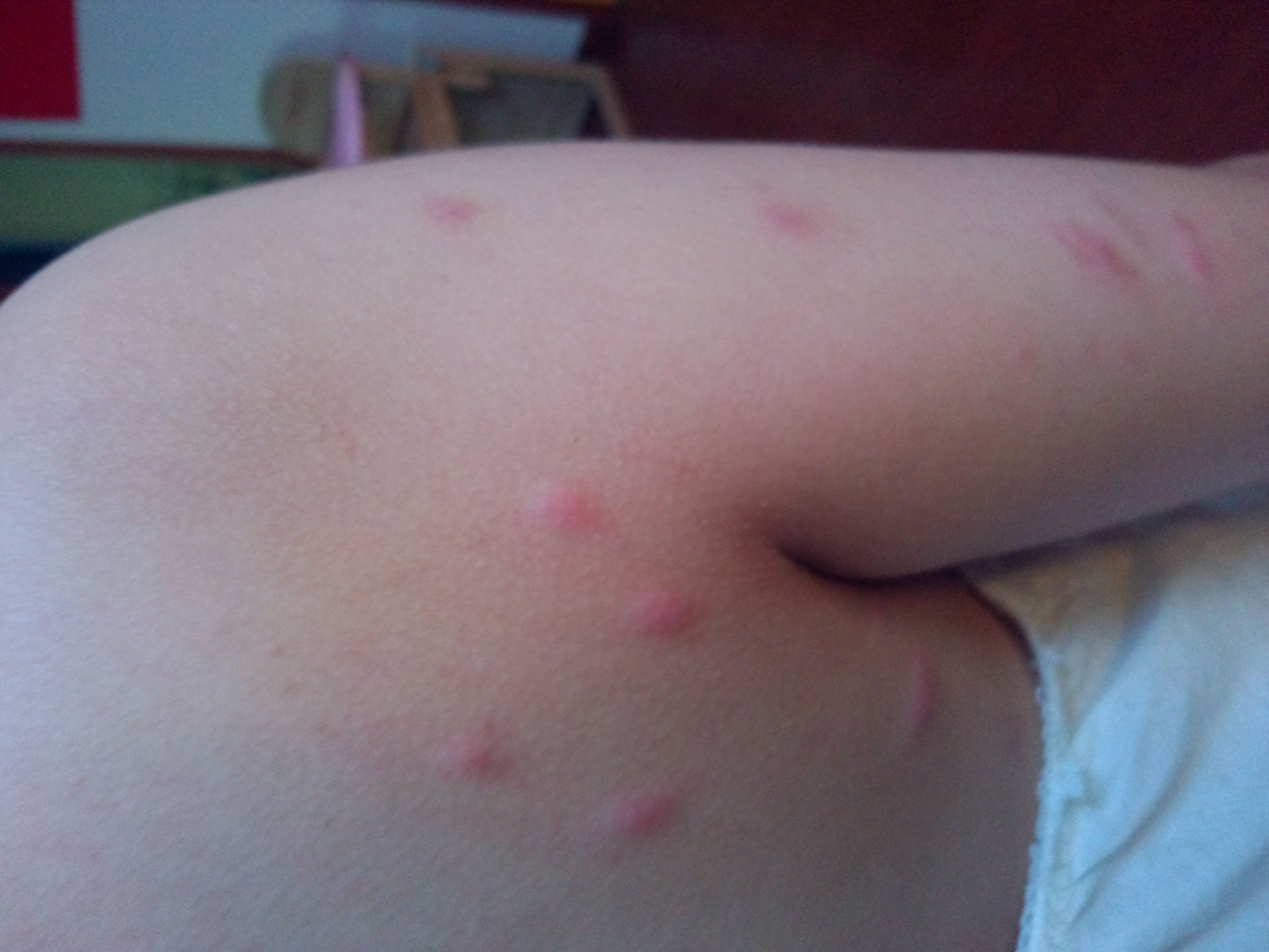 身上紅疙瘩圖片對照，了解皮膚問題的真相，身上紅疙瘩圖片對照，揭示皮膚問題真相