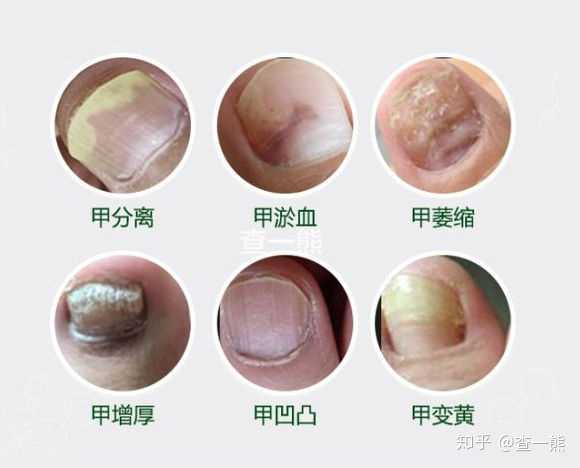 如何判斷自己是否得了灰指甲?,如何判斷自己是否得了灰指甲?詳細指南與解析。