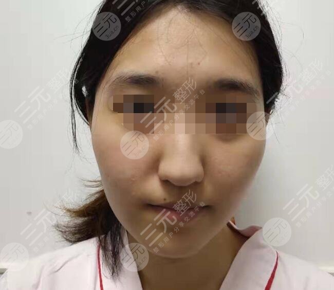 面部吸脂十天后的變化,圖片與經驗分享,面部吸脂十天,變化、圖片與經驗分享