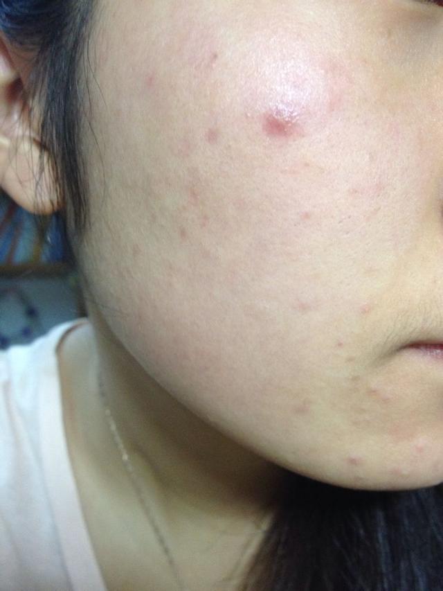 臉上起痘痘怎么快速消除——全方位指南,全方位指南,如何快速消除臉部痘痘?