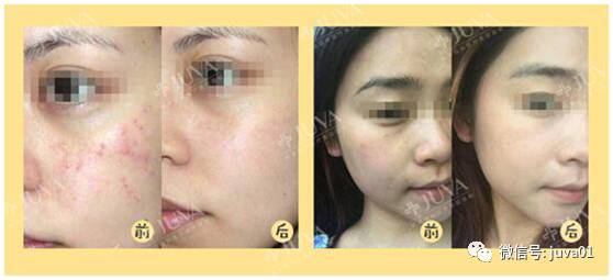 青春期長痘痘了怎么消除,全面解析與應(yīng)對方法,青春期痘痘消除全面解析與應(yīng)對方法指南