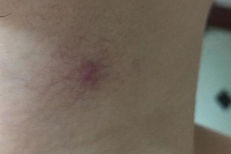 肝癌身上出現(xiàn)紅點(diǎn)圖片,癥狀解析與關(guān)注,肝癌身上紅點(diǎn)解析,癥狀、圖片及關(guān)注重點(diǎn)