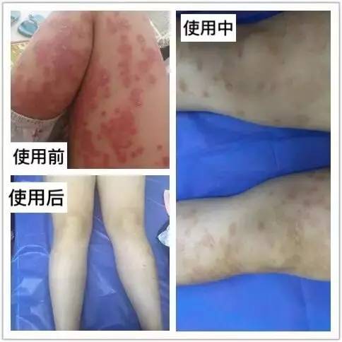 全面解析,100種皮膚病對照表圖片,100種皮膚病對照表圖片,全面解析皮膚病癥狀與類型