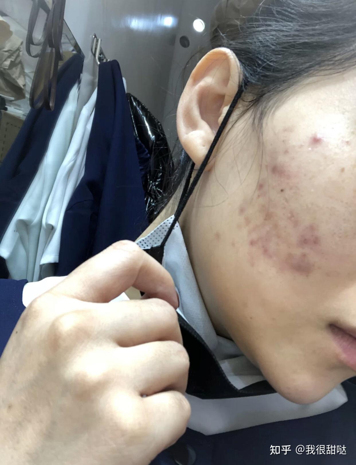 怎樣去除青春痘及痘印,全面解析有效方法,全面解析,青春痘與痘印的去除有效方法