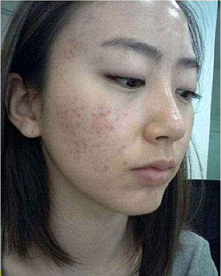 怎樣去除青春痘及痘印,全面解析有效方法,全面解析,青春痘與痘印的去除有效方法