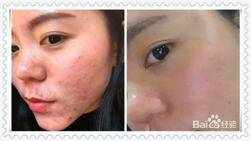 怎樣去除青春痘及痘印,全面解析有效方法,全面解析,青春痘與痘印的去除有效方法