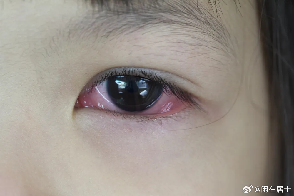 紅眼病30秒神奇治愈方法,揭秘快速恢復(fù)秘籍,紅眼病快速治愈秘籍,30秒神奇恢復(fù)方法揭秘