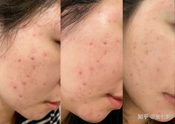 痘印多久會自己消失?全面解析痘印消失時間與影響因素,痘印消失時間全面解析,影響因素與消失時長探討