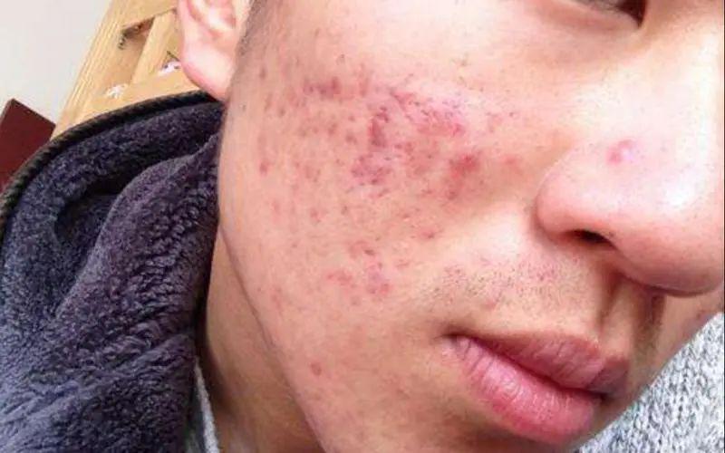 痘印多久會自己消失?全面解析痘印消失時間與影響因素,痘印消失時間全面解析,影響因素與消失時長探討