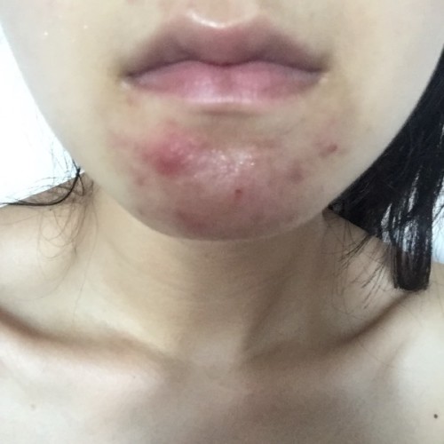 痘痘長(zhǎng)不出來(lái),肉里硬硬的,原因解析與應(yīng)對(duì)建議,痘痘無(wú)法冒出表面,內(nèi)部硬結(jié)成因解析及應(yīng)對(duì)之策