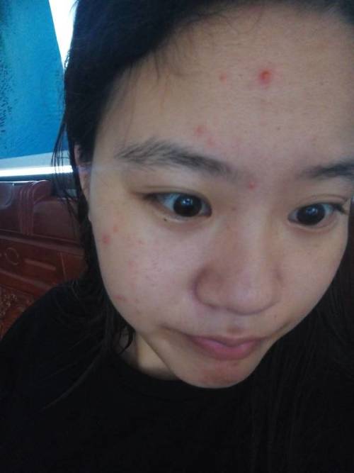 痘痘長(zhǎng)不出來(lái),肉里硬硬的,原因解析與應(yīng)對(duì)建議,痘痘無(wú)法冒出表面,內(nèi)部硬結(jié)成因解析及應(yīng)對(duì)之策