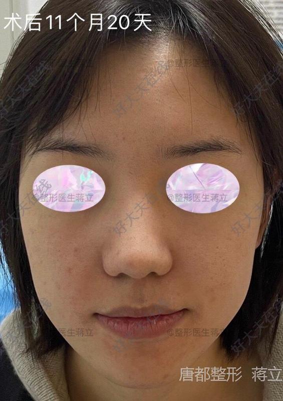 不動手術縮小鼻頭,自然方法與實用技巧,自然縮小鼻頭的方法與實用技巧分享