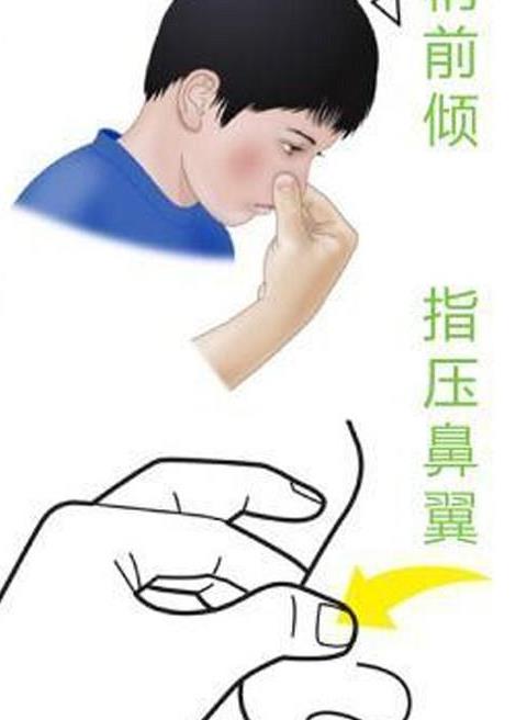 流鼻血的正確處理方法,流鼻血的正確應(yīng)對方法