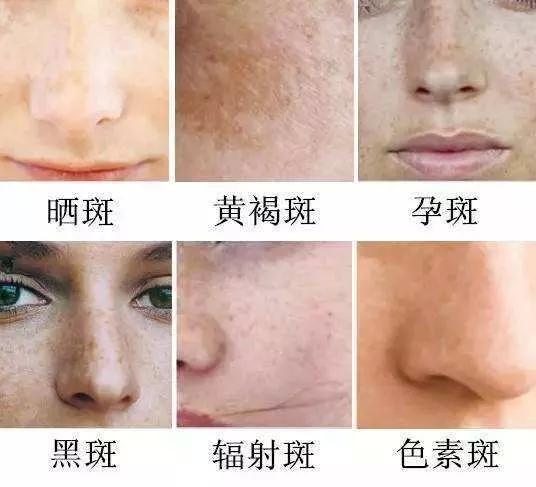 如何有效去除臉上斑點——全方位指南，全方位指南，如何有效去除臉上斑點