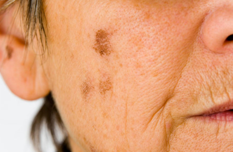 老年斑的形成原因及消除方法,老年斑的形成原因與消除方法全解析