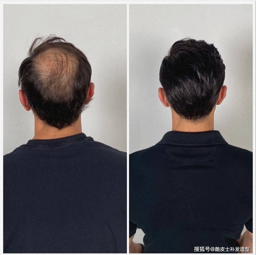 毛囊受損怎么恢復頭發,全面解析毛囊修復與頭發再生的方法,毛囊受損修復與頭發再生方法全面解析