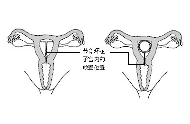 上環后同房過猛會移位嗎?深入了解與注意事項,上環后同房注意事項,過猛行為可能導致移位風險探討
