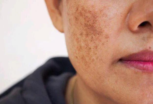 最簡單除老年斑的偏方,最簡單有效的老年斑去除偏方