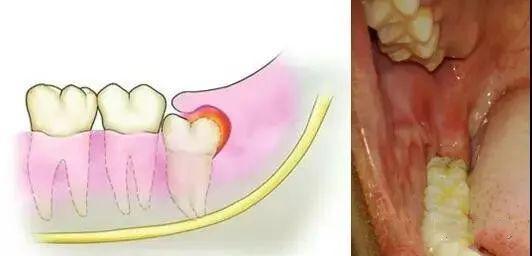 拔智齒多少錢一顆?一文解讀智齒拔除費用(2022年),2022年智齒拔除費用詳解,拔智齒多少錢一顆?一文解讀智齒拔除費用問題。