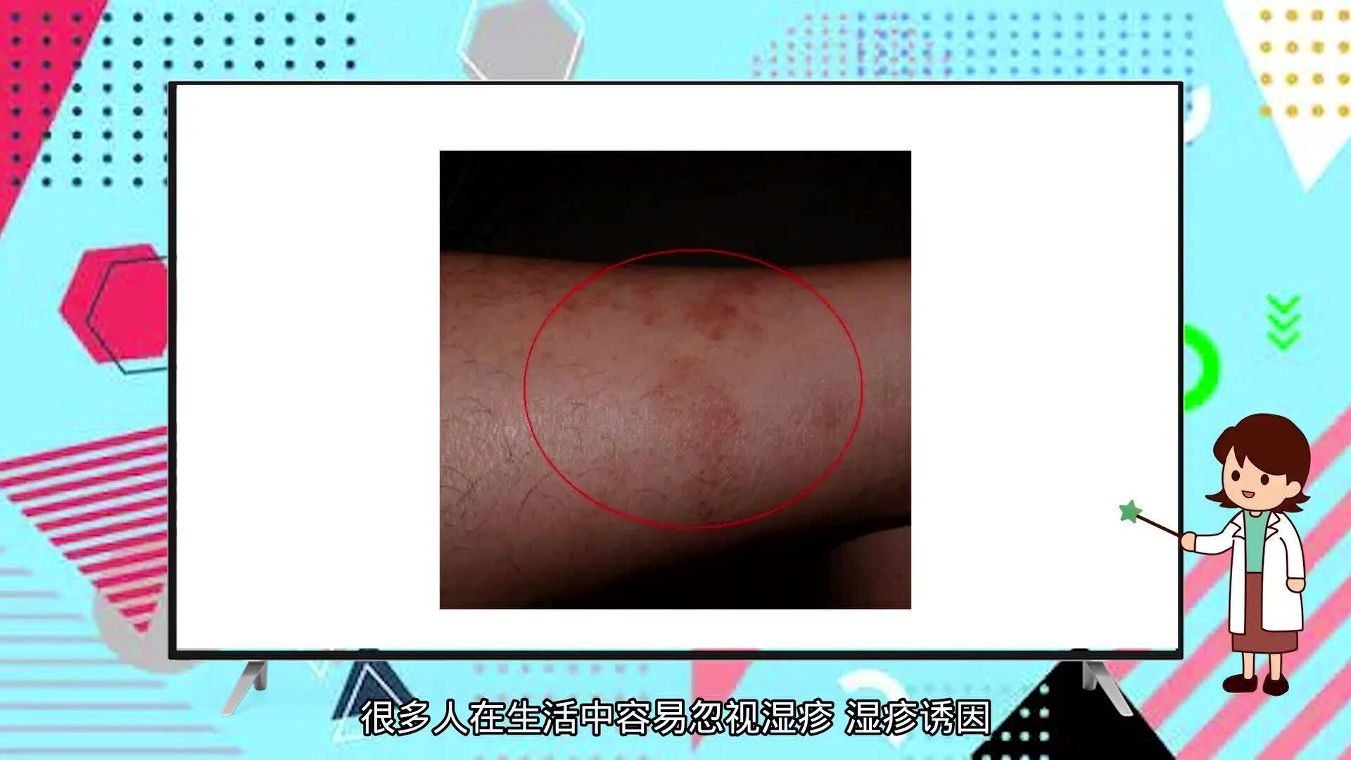 蕁麻疹夜晚止癢妙招，讓你遠離瘙癢困擾，蕁麻疹夜晚止癢小妙招，告別瘙癢煩惱