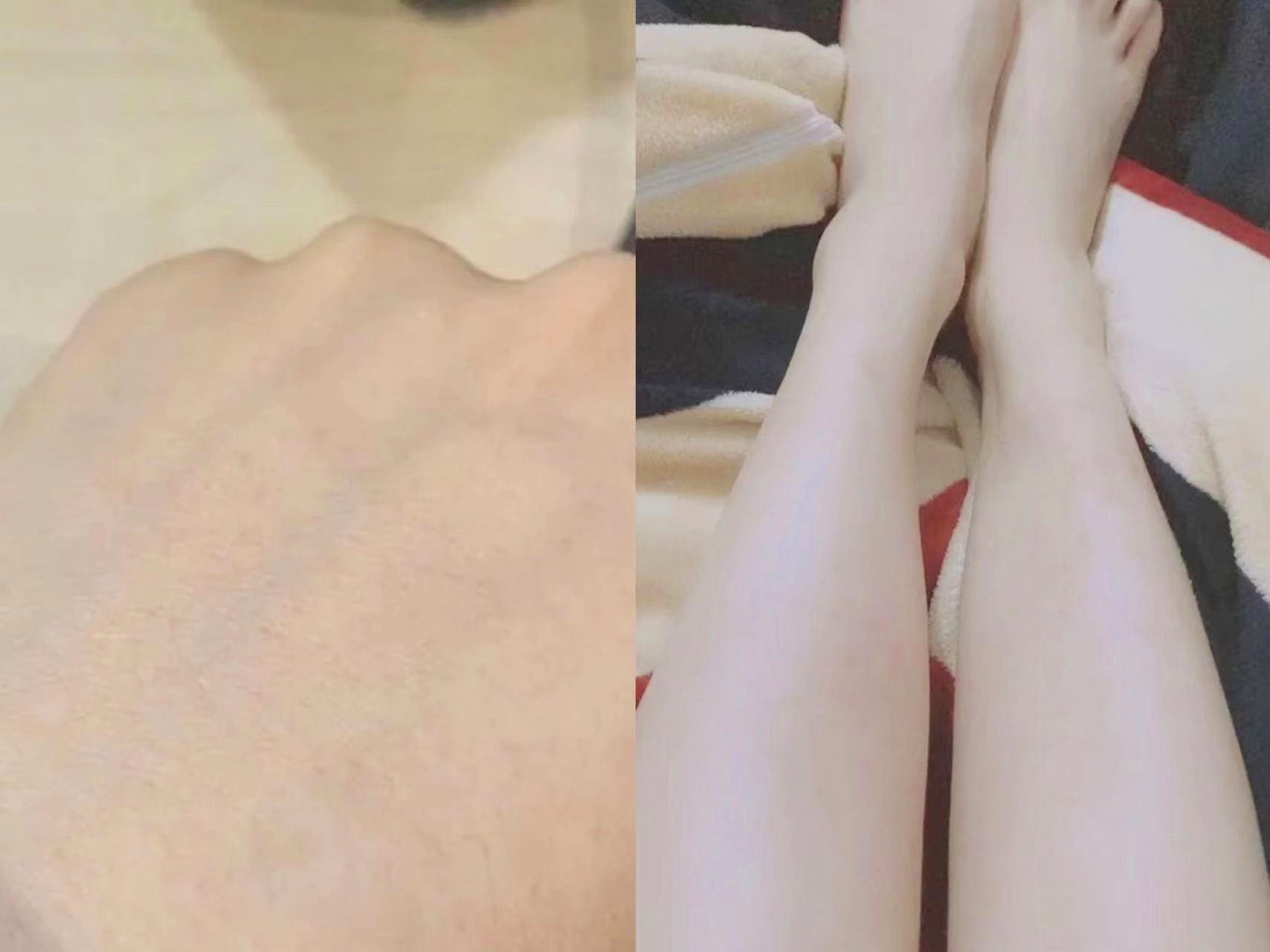 蕁麻疹夜晚止癢妙招,讓你遠離瘙癢困擾,蕁麻疹夜晚止癢小妙招,告別瘙癢煩惱