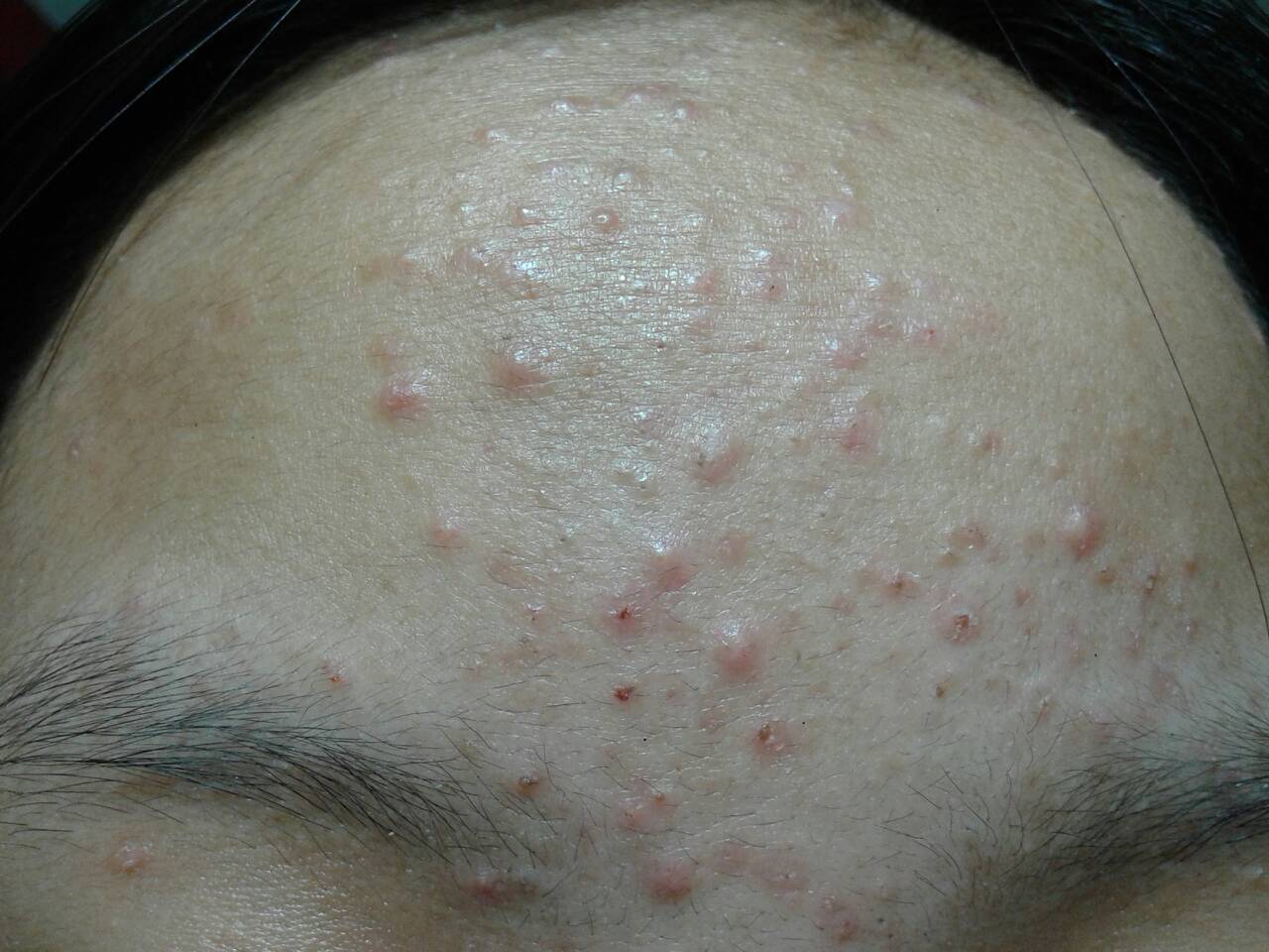 白頭粉刺圖片,了解、預(yù)防與應(yīng)對(duì),白頭粉刺詳解,圖片、預(yù)防與應(yīng)對(duì)策略