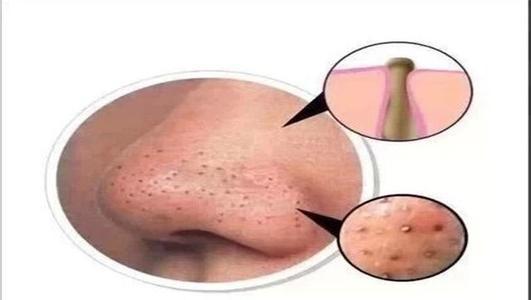 白頭粉刺圖片,了解、預(yù)防與應(yīng)對(duì),白頭粉刺詳解,圖片、預(yù)防與應(yīng)對(duì)策略