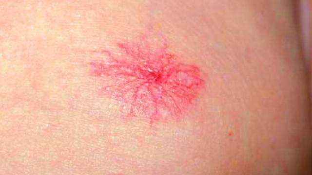 肝病身上紅點圖片,識別與理解,肝病身上紅點解析,圖片識別與理解指南