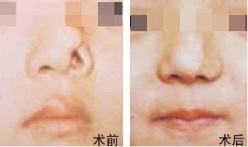 鼻整形手術費用詳解，多少錢？一切因素告訴你！，鼻整形手術費用全面解析，價格因素一網打盡！