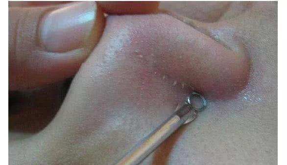 白色米粒小疙瘩圖片,解析與SEO優化策略,白色米粒小疙瘩圖片解析及SEO優化策略指南