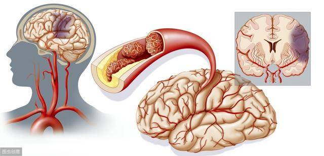 如何判斷自己是否腦供血不足——癥狀解析與應對策略,腦供血不足的判斷方法,癥狀解析及應對之策