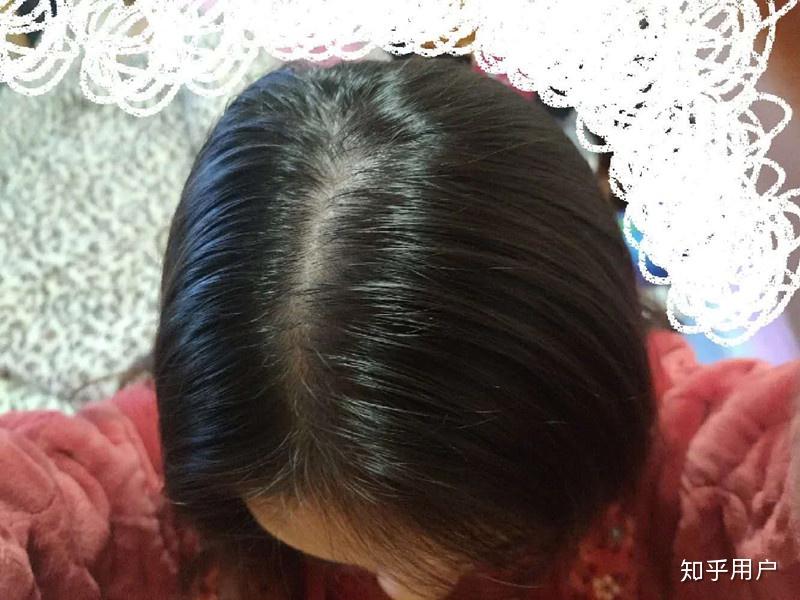 女人掉頭發(fā)嚴(yán)重怎么調(diào)理,全方位指南,女人嚴(yán)重脫發(fā)調(diào)理全方位指南