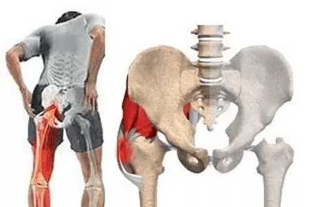 骨頭壞死了還能恢復嗎?——全面解析與康復指南,骨頭壞死能否恢復?全面解析及康復指南